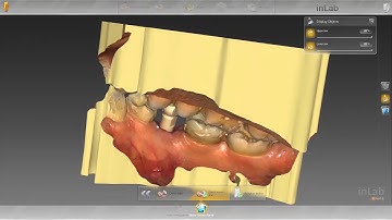 How to: Import Cerec to Exocad/3Shape