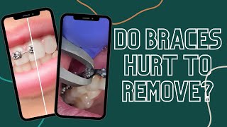Do Braces Hurt To Remove?