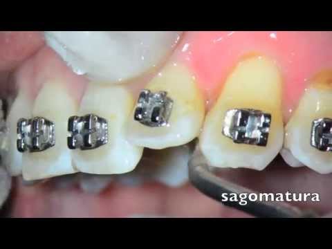 Strpping Tooth Orthodontic Stripping - Tooth Stripping - Sonostripping Tips ...