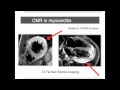 Why CMR Webinar: Introduction into Inflammatory Cardiomyopathy - Part I (viral myocarditis)