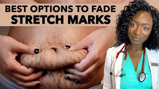 How To Fade Stretch Marks | Causes & Treatments + Best Products To Get Rid Of Stretch Marks