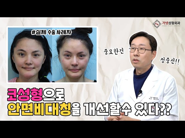 코성형으로 안면비대칭을 개선할수 있다? 코수술에서 중요한것은 정중선!!💥