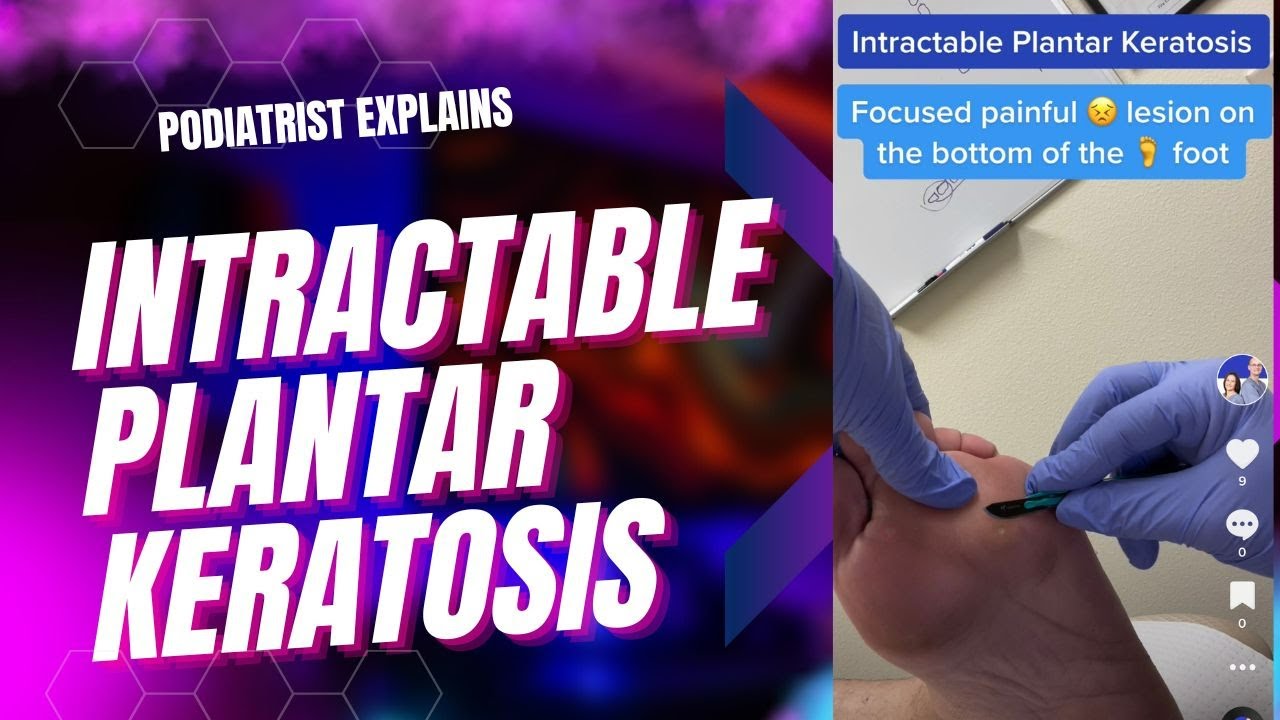 Do you feel like you have a pebble stuck on the bottom of the foot