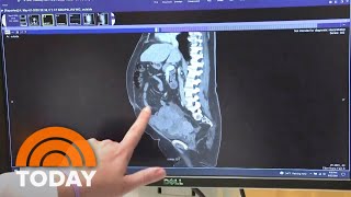 Ovarian Cancer Warning Signs You Should Notice