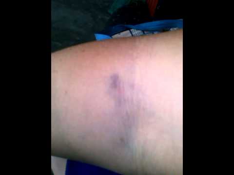 hematomas por analisis de sangre