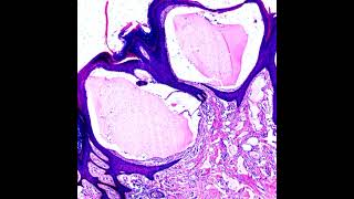 Histopathology of Lymphangioma Circumscriptum #shorts  #dermpath #dermatopathology #pathology