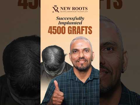 Hair Transplant in Mumbai (4500 Grafts) | Marathi #haircare #marathi #shorts