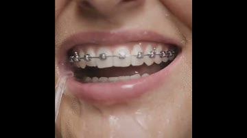 Traditional flossing can be tricky with braces—switch to a water flosser for effortless cleaning