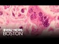 What to know about potential Logan Airport measles exposure