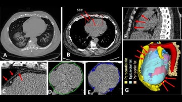 CT Heart segmentation using U-NET part two | training the model شرح عربي