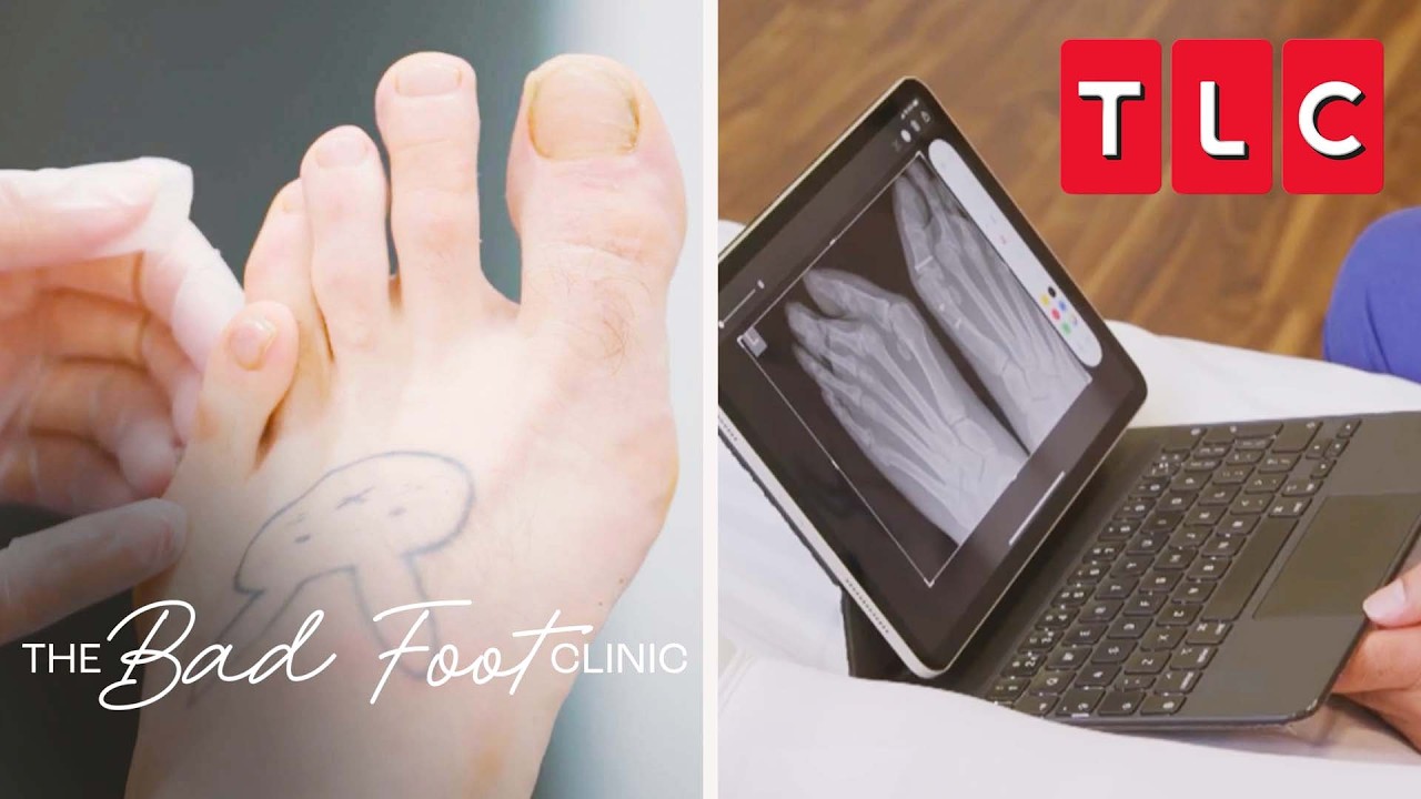 Toes in Serious Turmoil | Bad Foot Clinic | TLC