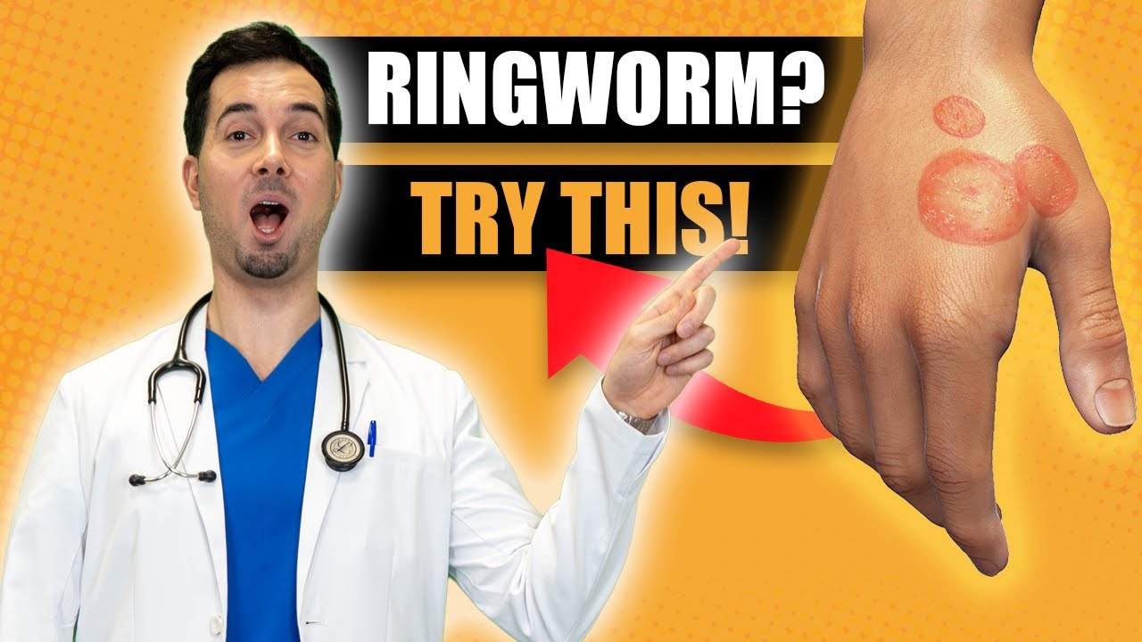 How To Get Rid of Ringworm Fast