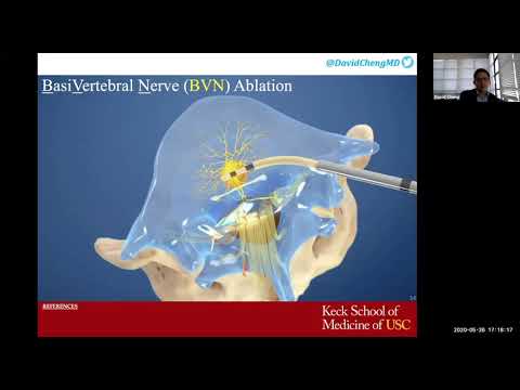 Basivertebral Nerve Ablation For Low Back Pain | Regenerative Treatments for Spine Conditions