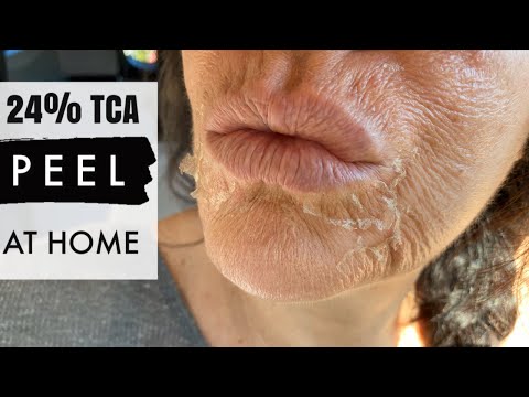 DIY 25% TCA PEEL AT HOME | Safety | Steps and day by day, 10 days