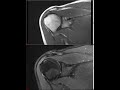 Shoulder mri approach to msk mri series