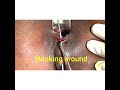 Surgical technique of SLOFT by Dr DU Pathak India