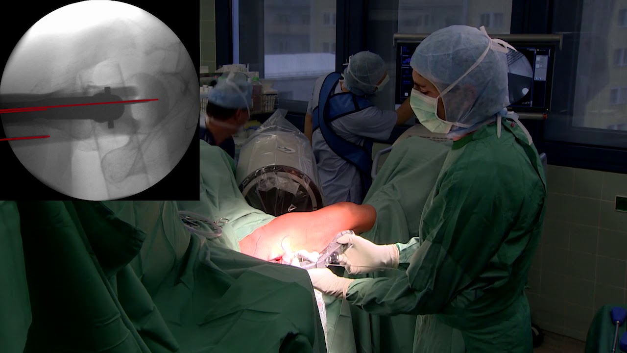 DePuy Synthes Live Surgery TFNA System