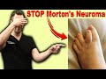 CURE Morton's Neuroma, Metatarsalgia & Ball of the Foot Pain FAST!