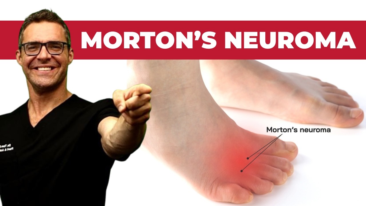 CURE Morton's Neuroma, Metatarsalgia & Ball of the Foot Pain FAST!