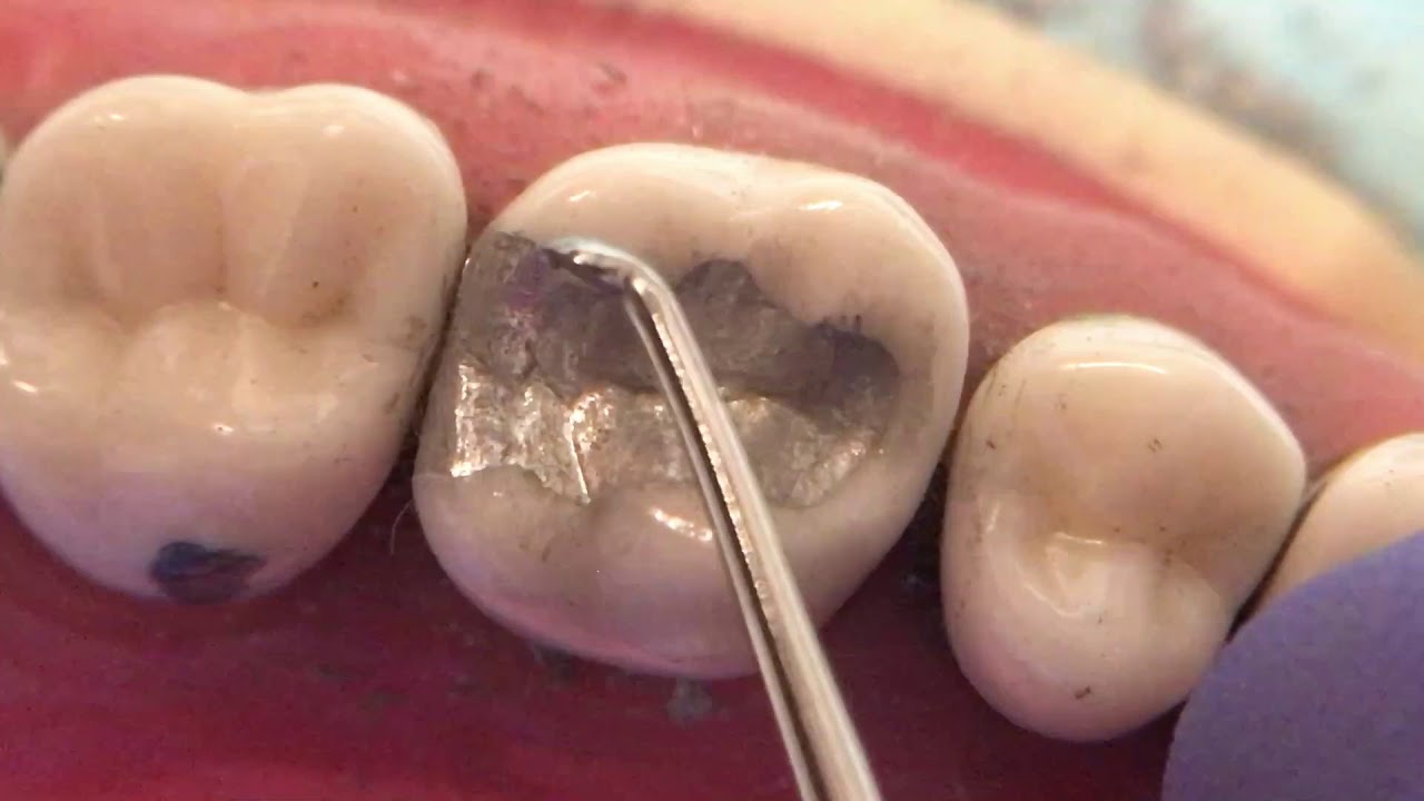 #3 DO Amalgam Refine MR 6 of 6