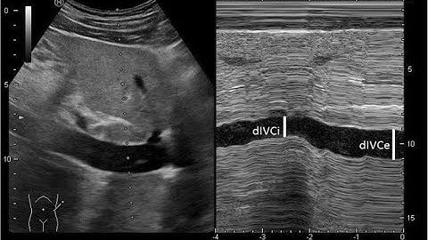 FLUID RESPONSIVENESS - DYNAMIC & STATIC MEASURES-                            DR PAVAN KUMAR VALA