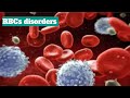 Microcytic anemia # RBCs disorders lecture - 2 ##medico #pathology