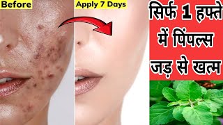 Pimples removal on face at home | पिंपल्स, मुंहासे, दाग धब्बे से हमेशा के लिए छुटकारा पाए #skincare