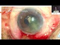 Aioc2024  gp190 topic  dr nilutparna deori wound ergonomics of 2 mm incision in msics