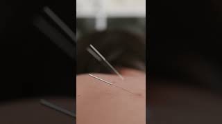 Discover Acupuncture at Neomed: Ancient Healing for Pain Relief, Stress Reduction, and Wellness!