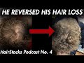 Catching hair loss early  hairstacks podcast no 4