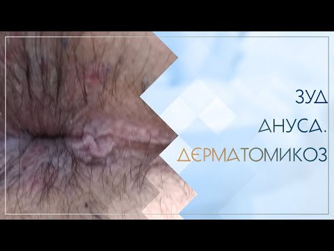 Видео: Болести на ануса - лечение на заболявания на ануса с народни средства и методи