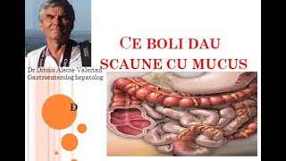 Ce inseamna scaune cu mucus - sfatul medicului gastroenterolog