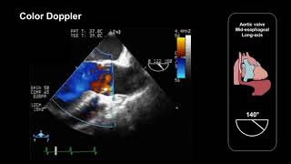 Assessing the aortic valve using TEE (mid-esophageal long-axis view)