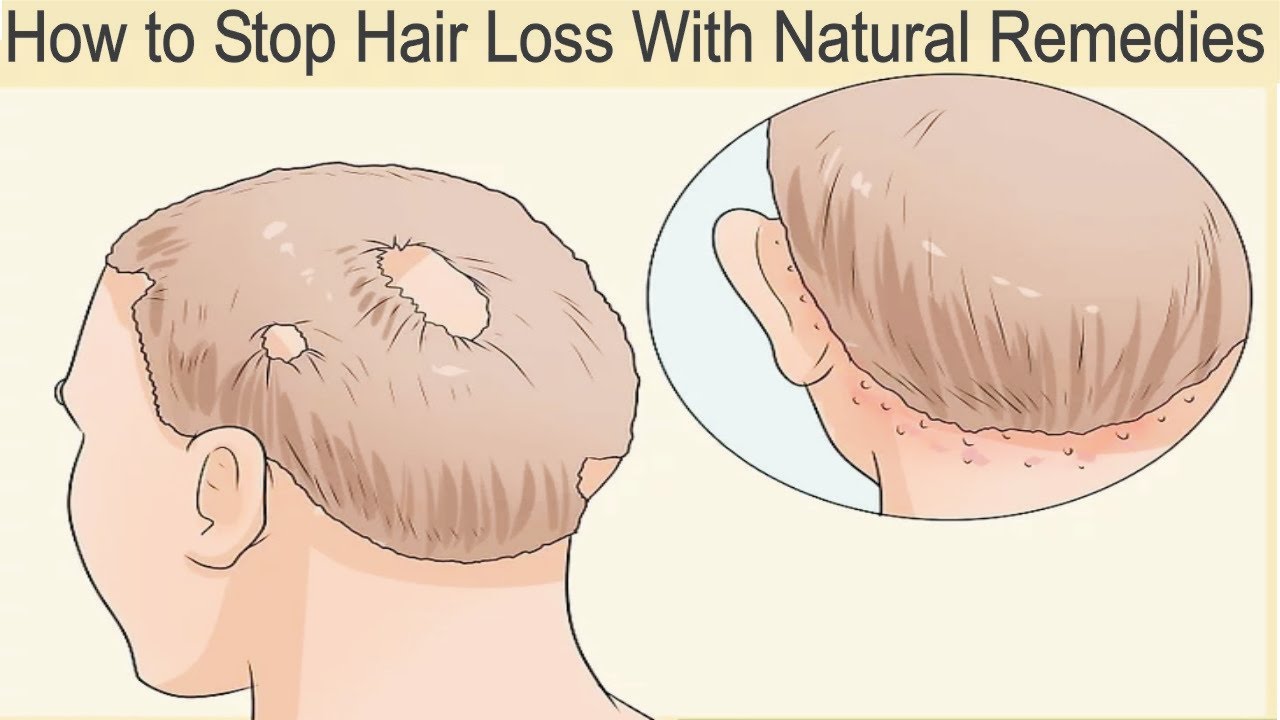 How to Stop Hair Loss With Natural Remedies - YouTube