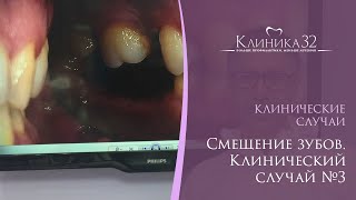 👋 Смещение зубов. Клинический случай №3