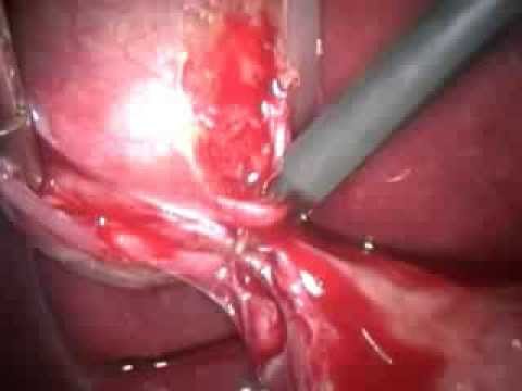 Laparoscopic Cholecystectomy (unedited-12)- Lap Chole In Acute Cholecystitis And Post ERCP Case