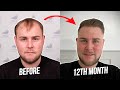 Lewis amazing results with smile  beforeafter  sime hair clinic