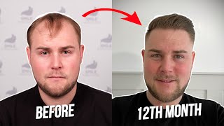 LEWIS' AMAZING RESULTS with SMILE! | Before&After | Sime Hair Clinic