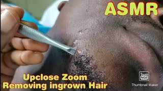 ASMR Upclose Zoom Removing ingrown hair from beard & moustache