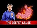 The Real Causes of Acid Reflux, Heartburn & GERD: Dr.Berg