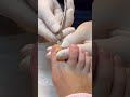 【肥厚爪ケア】#shorts
