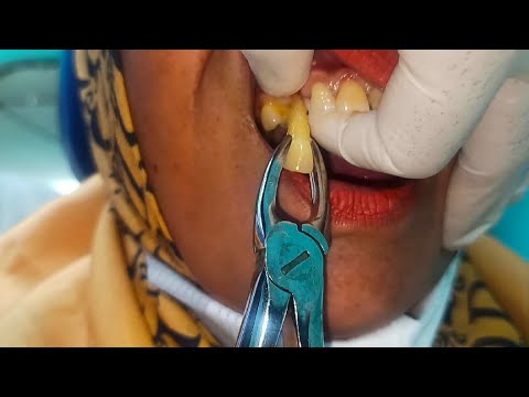 Video: Cara membilas mulut selepas pencabutan gigi