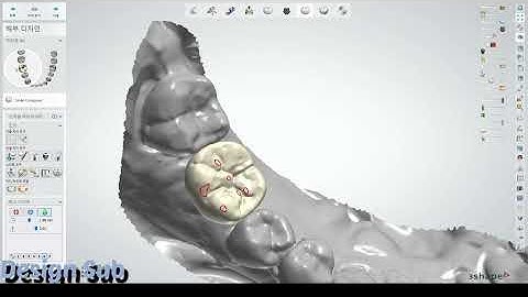 3shape design (simple case implant 🤨🤨) osstem