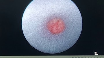 TÁN SỎI QUA DA ĐƯỜNG HẦM NHỎ.Bn KIÊN, 51T. Ngày 11/4/19. TS.BS. DƯƠNG VĂN TRUNG. 0913534343