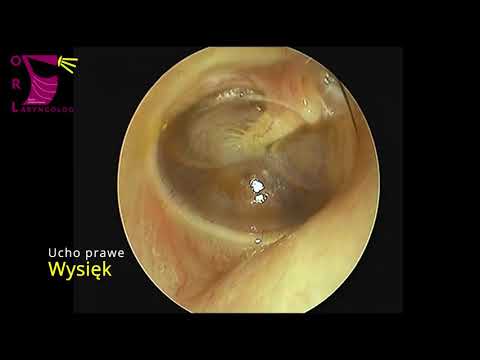 Wideo: Infekcja Ucha środkowego (zapalenie Ucha środkowego): Rodzaje, Przyczyny I Diagnoza