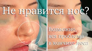 Ринопластика кончика носа