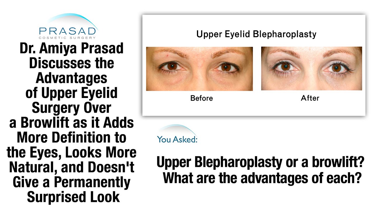 Brow Lift or Blepharoplasty - Why Upper Eyelid Surgery Results in a ...