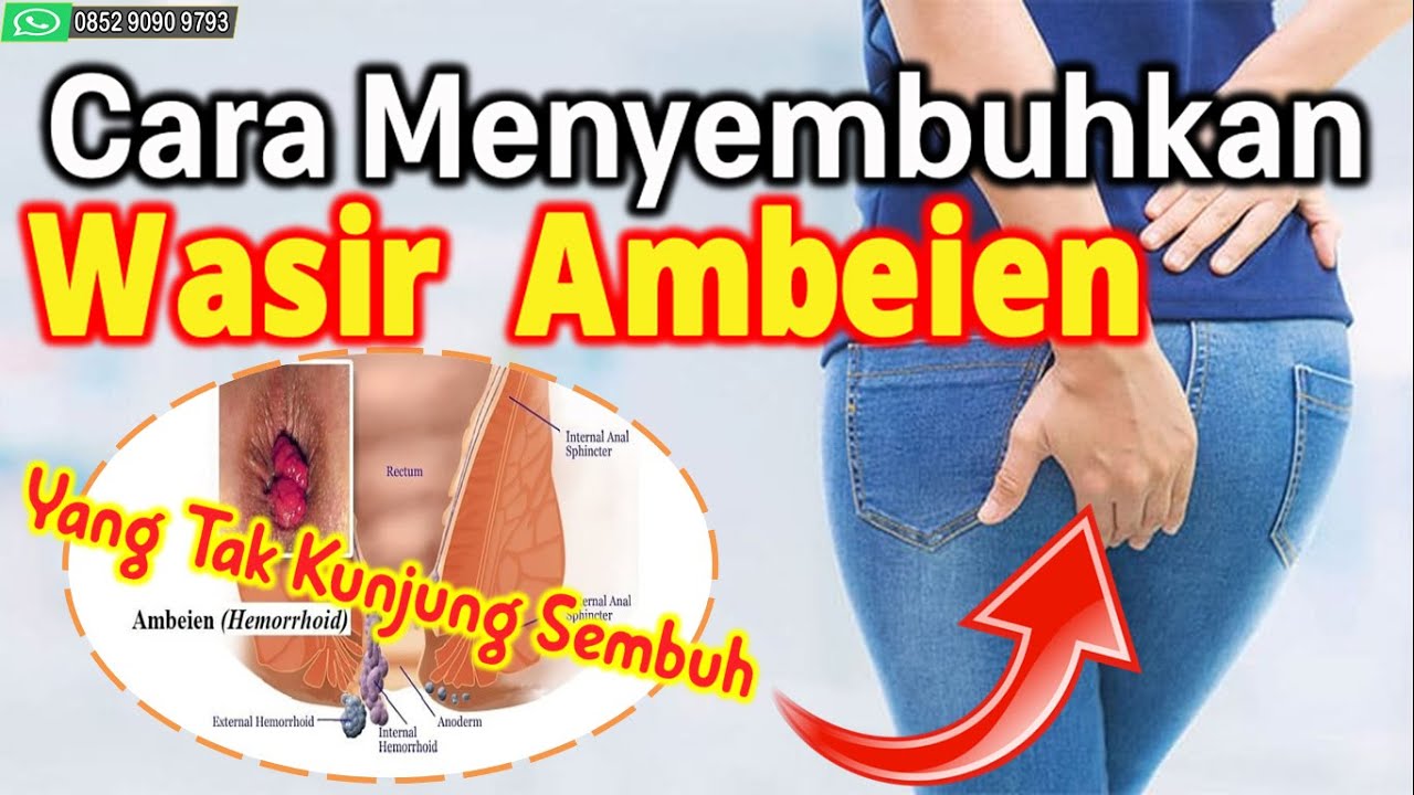 Cara Menyembuhkan Wasir Ambeien Yang Tak Kunjung Sembuh