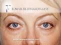 Blepharoplasty (Eyelid Surgery) at www.PearsonFaces.com default Blepharoplasty (Eyelid Surgery) at www.PearsonFaces.com