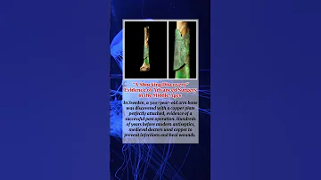 Evidence Of Advanced Medieval Surgery Discovered Copper Plates On Arm Bones 